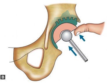 Illustration 28 for Optimizing Acetabular Component Cementation for Superior Outcomes