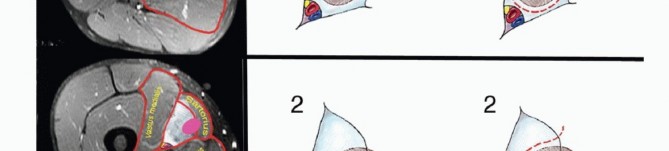 Illustration 4 for Optimizing Resection: An Overview of Surgical Approaches for Space Sarcomas