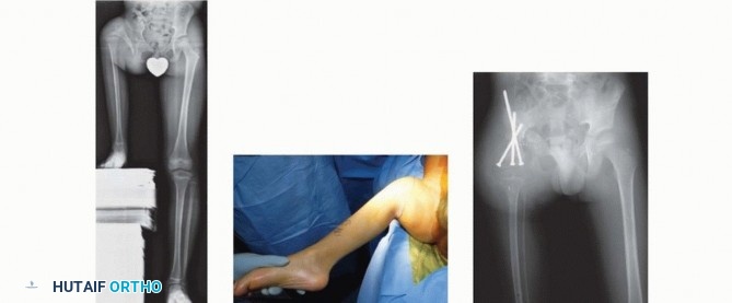 Illustration 13 for Treatment for Congenital Femoral Deficiency: What You Need to Know