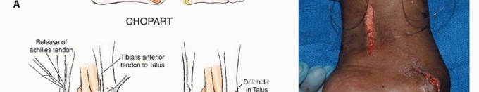 Illustration 28 for Treating Tumors of the Foot: Optimizing Amputation & Resection