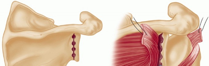 Illustration 31 for Finally Treat Recurrent Posterior Instability of the Shoulder