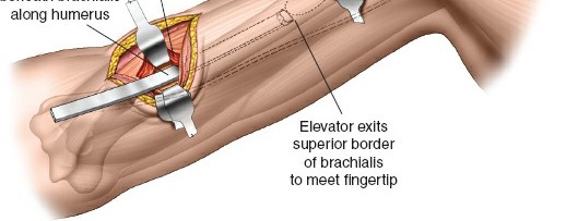 Illustration 28 for Mastering the Approach to the Distal Humerus: Safety & Skills