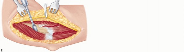 Illustration 57 for Surgical Approaches to Shoulder & Elbow: Pearls and Pitfalls