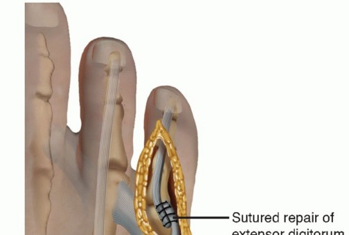 Illustration 30 for Toe Deformity Pain? Rebalance Flexor to Extensor for Relief
