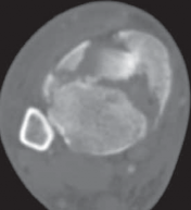 Illustration 18 for Optimizing ORIF for Tibial Plafond Fractures: A Modern Approach