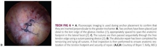 Illustration 139 for Periarticular Arthroscopy: Addressing Medius & Minimus Tears