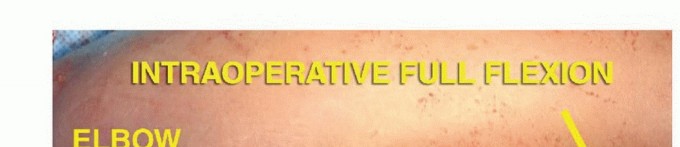 Illustration 24 for Distal Humeral Resection: Safe Techniques for Limb Preservation