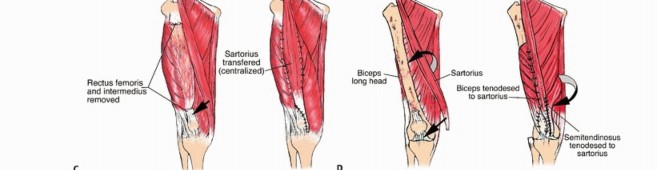 Illustration 6 for Limb-Sparing Quadriceps Resection: Superficial Femoral Artery