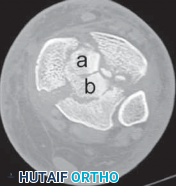Illustration 42 for Optimizing ORIF for Tibial Plafond Fractures: A Modern Approach
