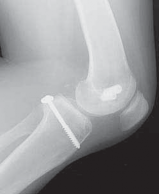 Illustration 25 for Cruciate Ligament Repair: Definitive Guide to Treatment & Recovery