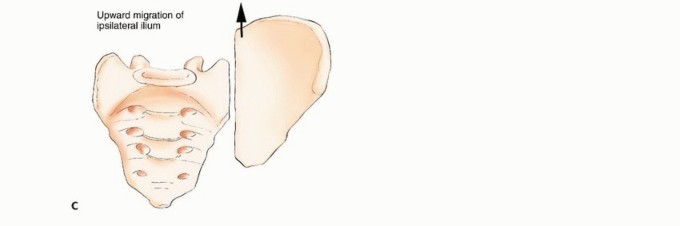 Illustration 47 for Pelvic Metastasis Surgery: A Component of the Utilitarian Approach