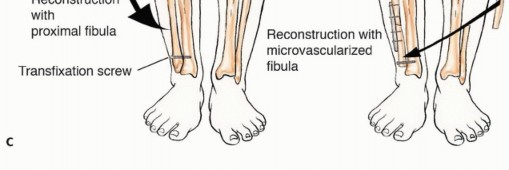 Illustration 41 for Beyond Amputation: The Type I Resection in Fibular Tumor Surgery