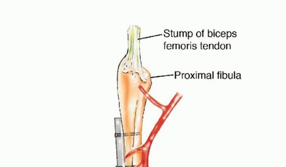 Illustration 39 for Free Vascularized Fibular Grafts: Solving Complex Bone Defects
