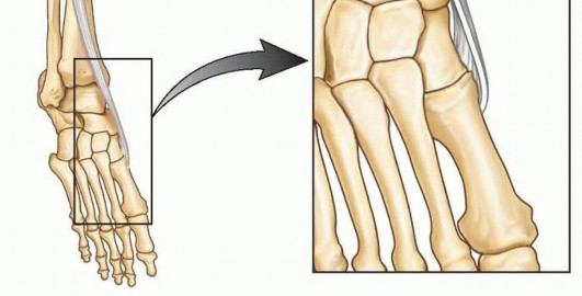 Illustration 4 for Why Anterior Tibialis Muscle Transfer Fixes Clubfoot