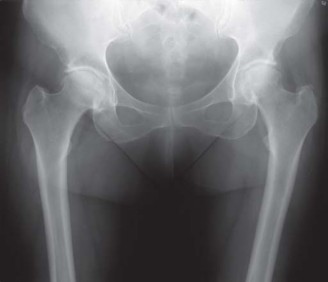 Illustration 78 for Collum Femoris Preserving: Achieve Better Primary Hip Outcomes