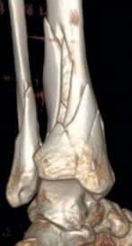 Illustration 17 for Decoding Pilon Fractures: Anterolateral and Medial Fragments Revealed