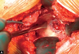 Optimizing Acetabular Component Cementation for Superior Outcomes