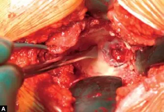 تثبيت مفصل الورك بالأسمنت: دليلك الشامل لعملية ناجحة ونتائج تدوم طويلاً في صنعاء