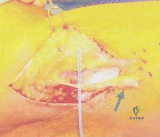صورة توضيحية لـ ألم الكوع الجانبي غير النمطي: تشخيص وعلاج حالات وتر ECRB ومتلازمة النفق الكعبري المعقدة