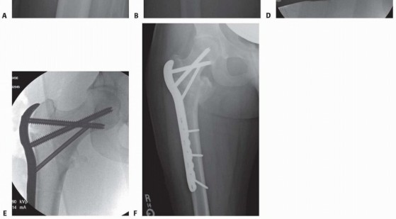 Illustration 20 for ORIF for Peritrochanteric Hip Fractures: Achieve Stable Mobility