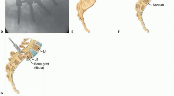 Illustration 19 for Mastering High-Grade Spondylolisthesis: Posterolateral and Interbody Fusion