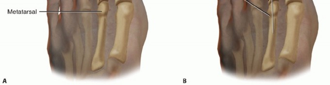 Illustration 15 for Toe Deformity Pain? Rebalance Flexor to Extensor for Relief