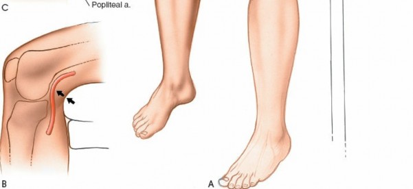 Illustration 46 for Mastering Knee Approaches: Spotlight on Superficial Medial Ligament