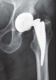 Illustration 3 for Kinectiv® Stem: Modular Necks for Primary THA Success