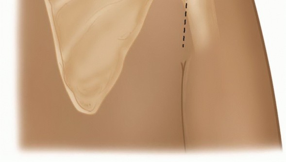 Illustration 11 for Mastering the Treatment of Recurrent Posterior Shoulder Instability