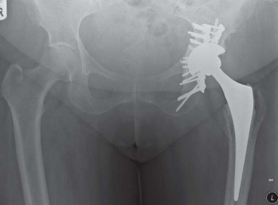 Illustration 40 for Management of Periprosthetic Fractures: An Expert Surgical Guide