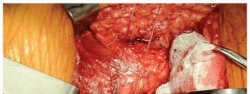 صورة توضيحية لعملية قطع عنق الفخذ