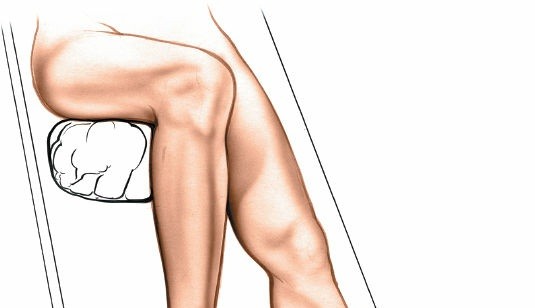 Essential Dorsal Approach for Second, Third, Fourth MTP Joints