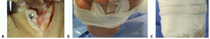 Illustration 31 for Plantar Plate Repair: End Lesser Toe Pain & Instability