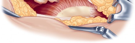 Illustration 44 for Direct Lateral Hip: Optimize Exposure with Sharp Curved Hohmann