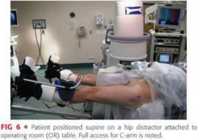 Illustration 60 for Precision Hip Arthroscopy: Unlock Access to the Peripheral Compartment