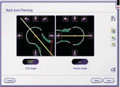 Illustration 33 for Minimizing Risks: Computer Navigation in Hip Resurfacing Arthroplasty
