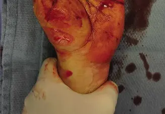 صورة توضيحية لـ إصابة العصب المتوسط والأوتار القابضة في الساعد: دليل شامل للتعافي مع الأستاذ الدكتور محمد هطيف