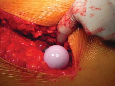 Illustration 58 for Unlock better THA: The technique of short stem for less invasiveness