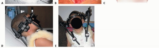 Illustration 28 for Addressing Cervical Spine Instability with Posterior Arthrodesis