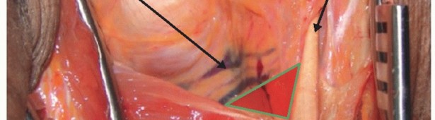 Illustration 30 for Restore Shoulder Function with Latissimus Dorsi Tendon Transfer