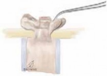 Illustration 14 for Optimizing Instrumentation for Neuromuscular Scoliosis