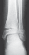 Illustration 14 for Pediatric Ankle Fractures: Management to Prevent Long-Term Issues