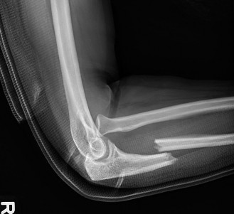 Optimal Treatment for Monteggia Fracture Dislocations in Adults