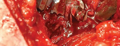 Illustration 110 for Femoral Stem Revision: Posterior Approach for Better Outcomes