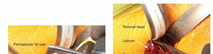 Illustration 16 for Anterior FAI Relief: Mini-Open Anterior Approach Explained