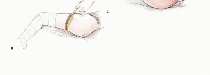 Illustration 15 for Mastering Hip Disarticulation: Through the Hip Joint Capsule