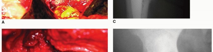 Illustration 6 for Osteolysis Solved: Polyethylene Liner Exchange for Well-Fixed Components