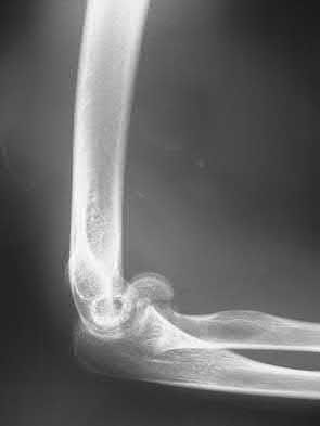 Illustration 199 for OrthoCash: Trauma MCQs & Cases for a yearold woman