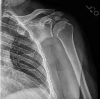 تكلس أوتار المرفق: دليل شامل للأسباب، الأعراض، التشخيص والعلاج مع الأستاذ الدكتور محمد هطيف