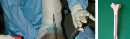 Illustration 19 for The Proxima: Why This Proximally Loading Implant Preserves Bone